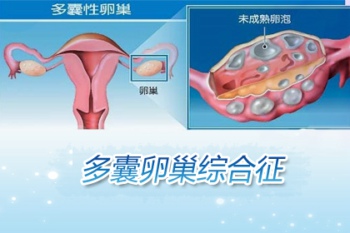 多囊卵巢腹腔镜下楔形打孔术