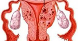 女性如何诊断子宫内膜异位