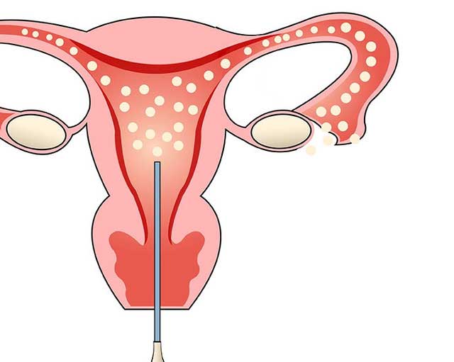 输卵管通液对身体有什么影响危害呢
