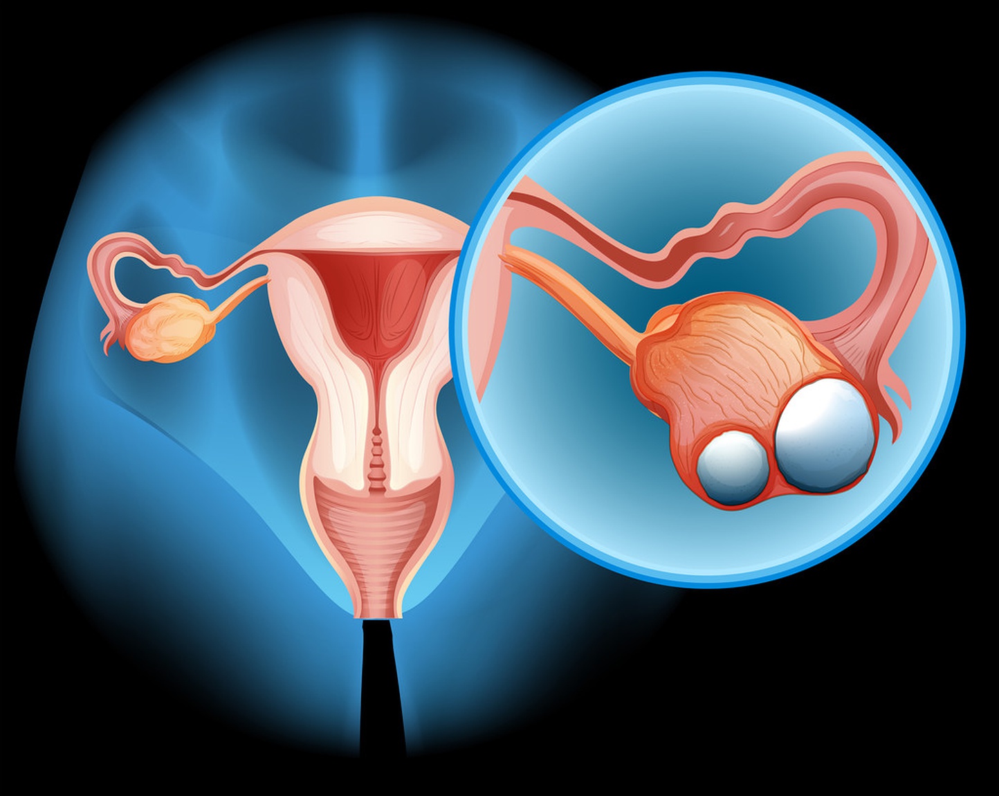 怎么预防卵巢囊肿