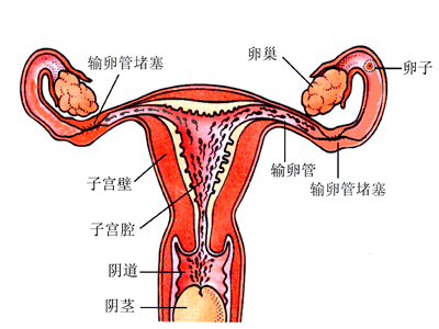输卵管堵塞图