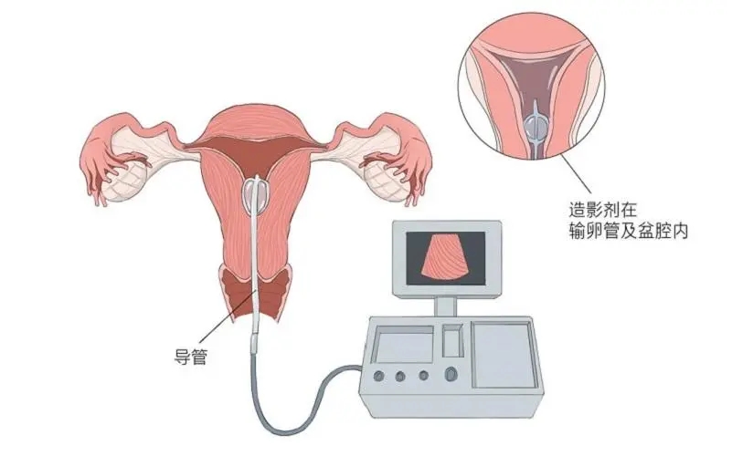 做完输卵管造影多久可以怀孕?